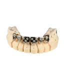GOLD TOOTH CROWN