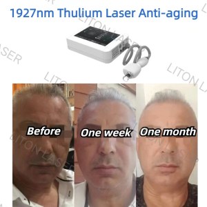 15W Power Thulium Laser 1927+1550nm Equipment