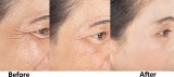 What Is CO2 Fractional Laser Treatment for Skin Resurfacing?