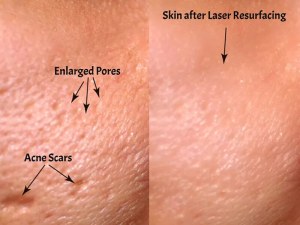 Scar Treatment with Fractional CO2 Laser Skin Resurfacing