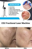 Fractional CO2 Laser: Essential Things You Should Know About This Acne Scar Treatment