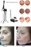 Complete Guide to CO2 Laser Resurfacing