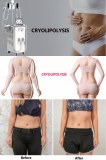 Analysis of the cryolipolysis slimming machine advantages and disadvantages