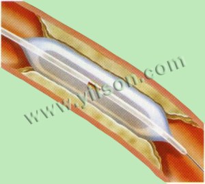 CTO Balloon Catheter