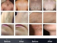 Laser hair removal – a step-by-step process