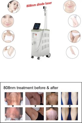 Diode Laser Hair Removal VS. IPL Hair Removal