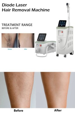 Diode Laser Hair Removal – Mechanism, Benefits and Queries!