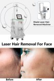 Diode laser for face hair removal