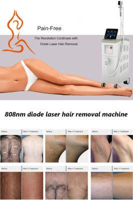 Diode laser hair removal has been a revolution in cosmetic dermatology