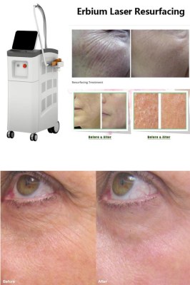 Fractional resurfacing lasers: Erbium laser