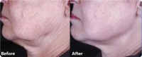 HIFU - Face Lift, Body Lift, Skin Tightening