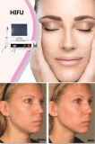 Non-surgical facial and skin rejuvenation with HIFU