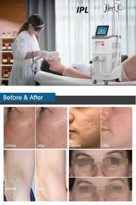 Everything you need to know before trying IPL laser treatment