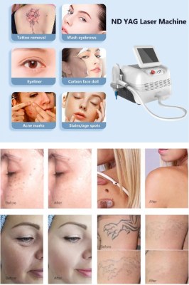 What are the treatments applied with Q-switched ND YAG laser?