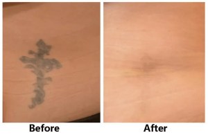 Common Skin Issues Treated with Picosecond Laser