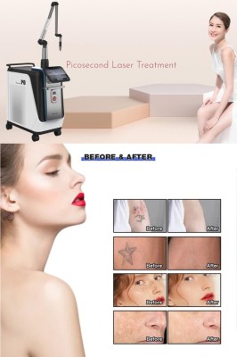 Q&A focused on the Picosecond laser treatment