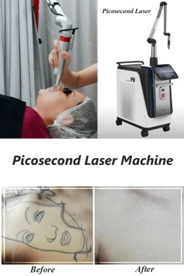 The complete guide to picosecond laser treatment