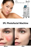 IPL therapy benefits for clear skin