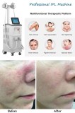 IPL photofacial remove imperfections