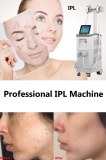 What to expect before, during, and after IPL photofacial treatment