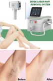 How long does laser hair removal last?