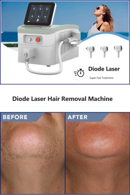 Things you need to know about laser hair removal treatment