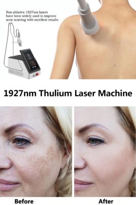 1927nm Thulium Laser Skin Rejuvenation System