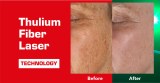 Thulium Laser Treatment for Skin Refresh